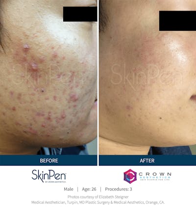 Microneedling Before & After Gallery - Patient 130106223 - Image 1