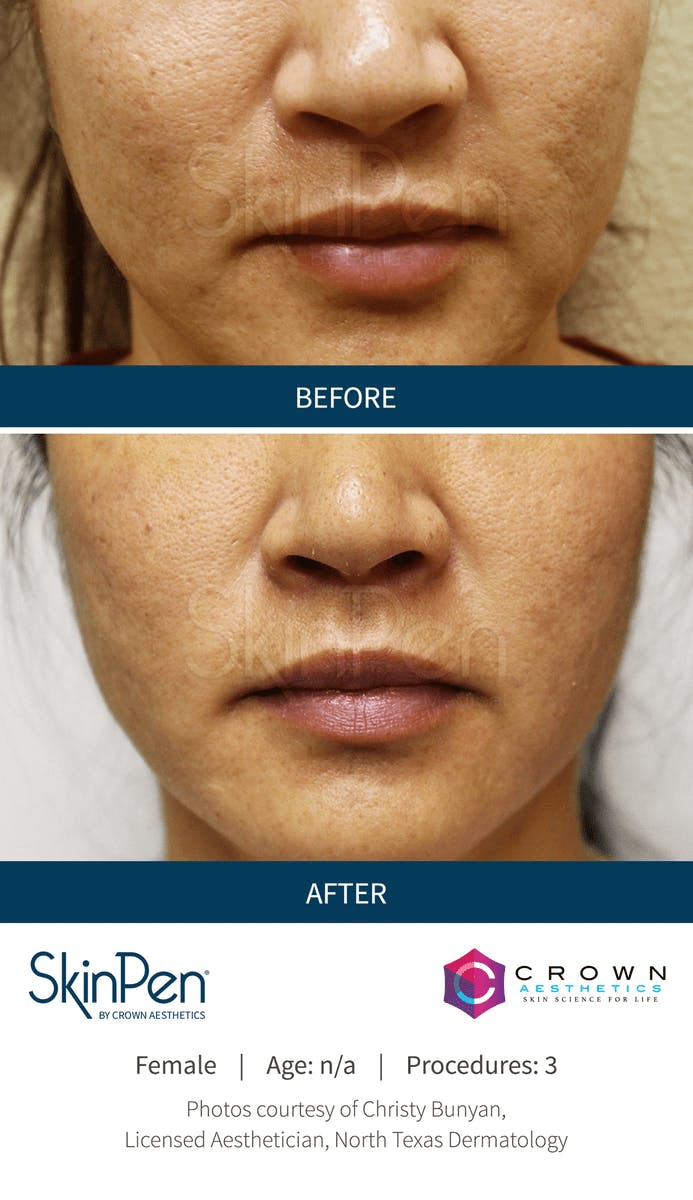 Microneedling Before & After Gallery - Patient 130106224 - Image 1