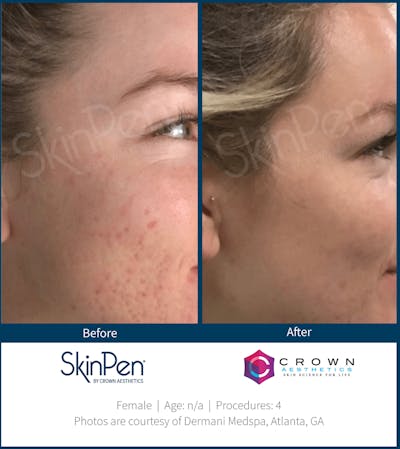 Microneedling Before & After Gallery - Patient 130106225 - Image 1