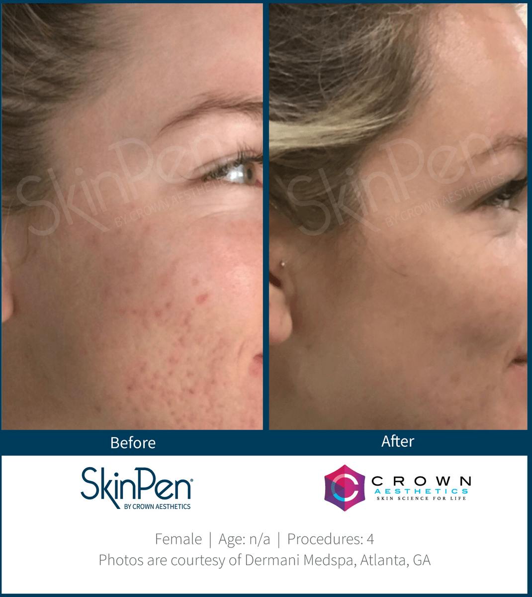 Microneedling Before & After Gallery - Patient 130106225 - Image 1