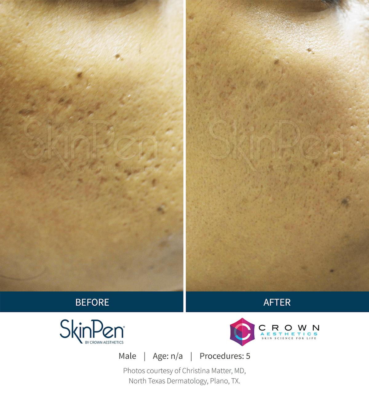 Microneedling Before & After Gallery - Patient 130106226 - Image 1