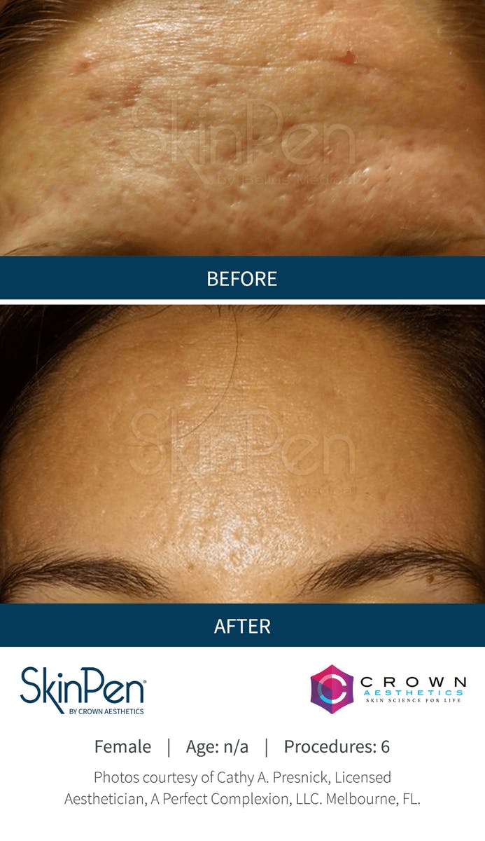Microneedling Before & After Gallery - Patient 130106227 - Image 1