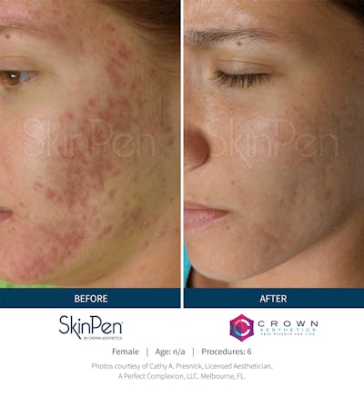 Microneedling Before & After Gallery - Patient 130106228 - Image 1