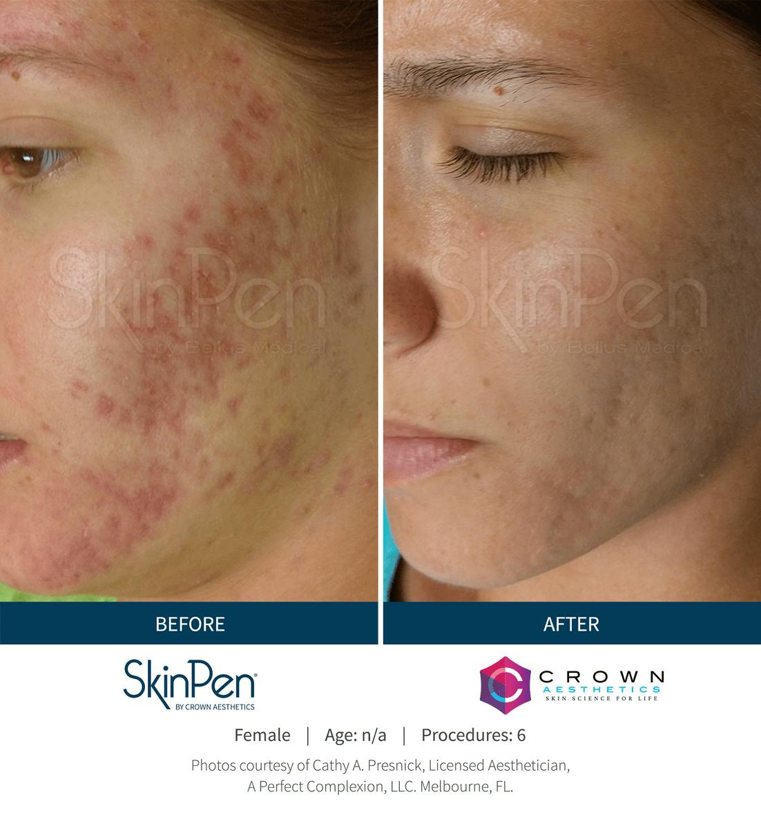 Microneedling Before & After Gallery - Patient 130106228 - Image 1