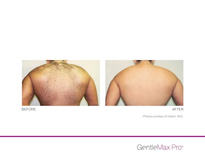 Laser Hair Removal Before & After Gallery - Patient 130156934 - Image 1