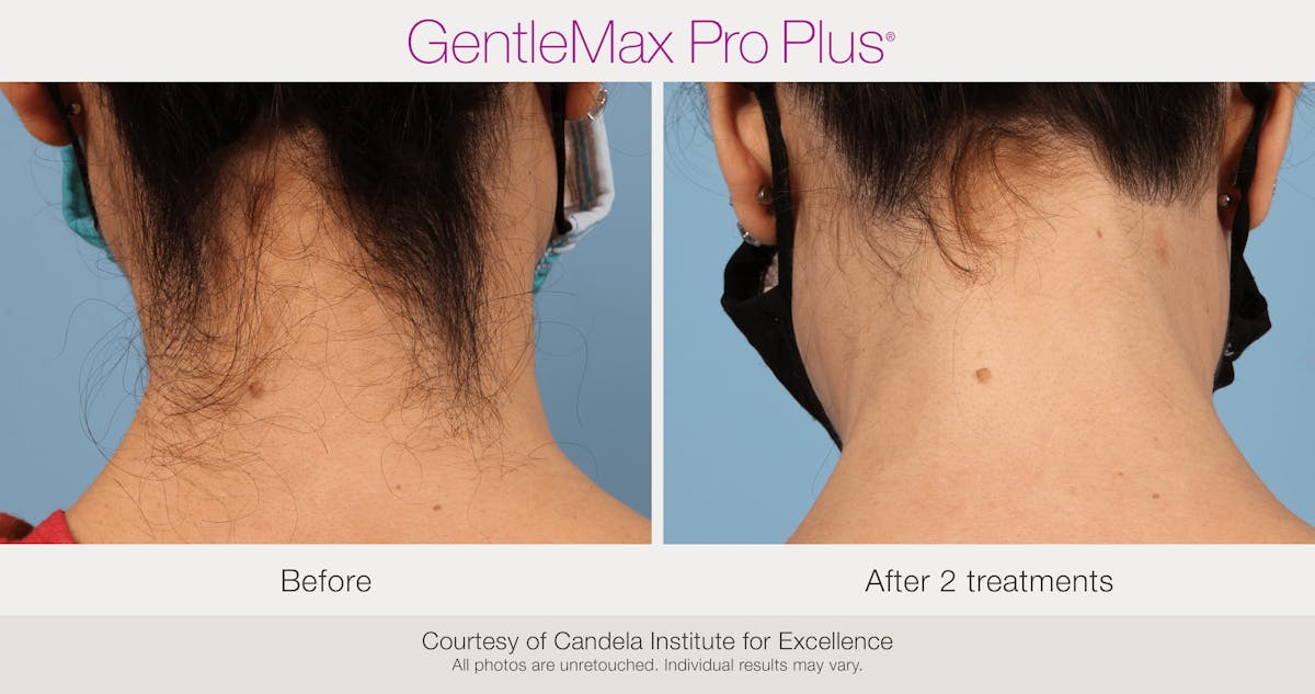 Laser Hair Removal Before & After Gallery - Patient 130156935 - Image 1