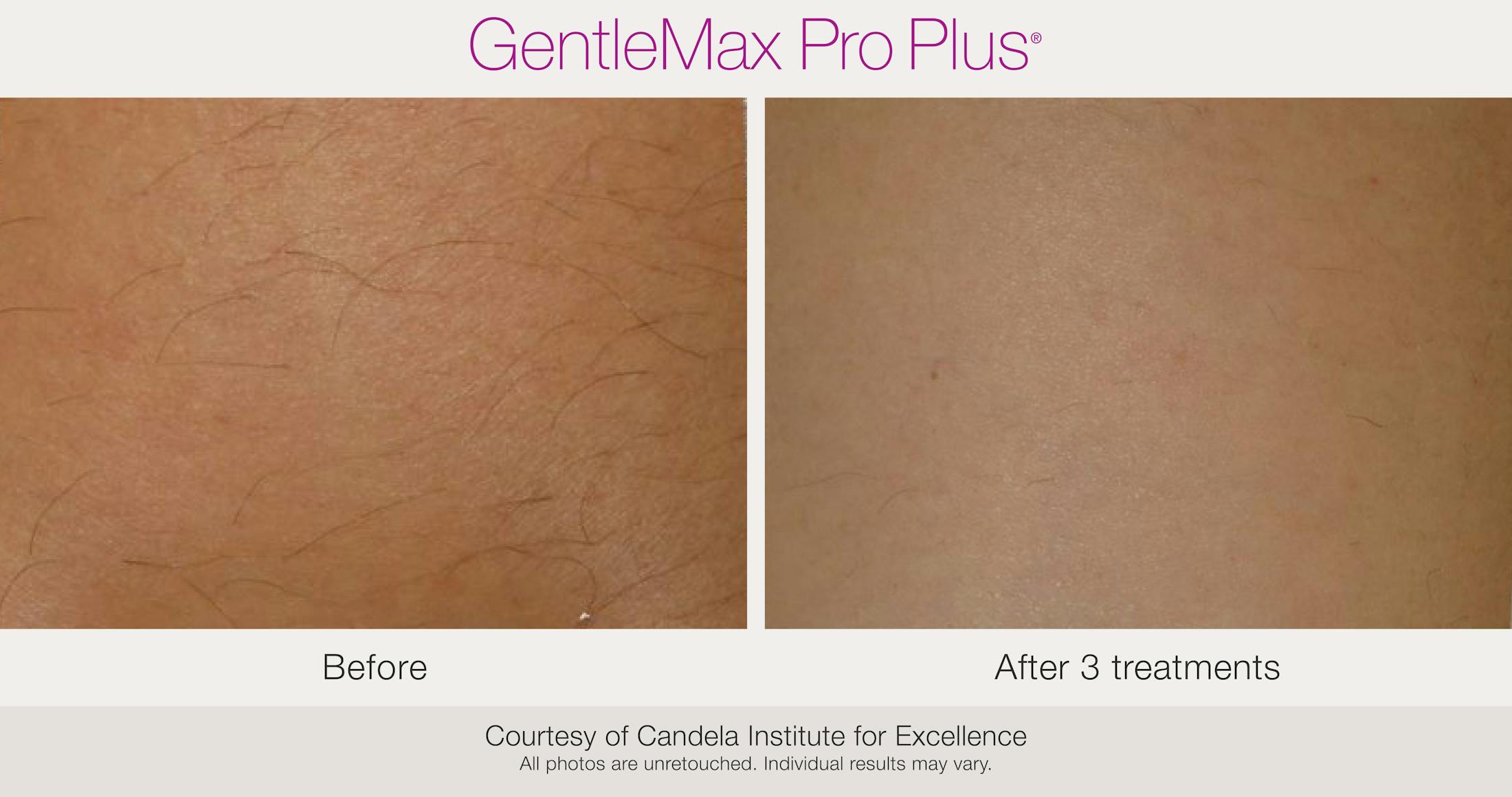 Laser Hair Removal Before & After Gallery - Patient 130156936 - Image 1