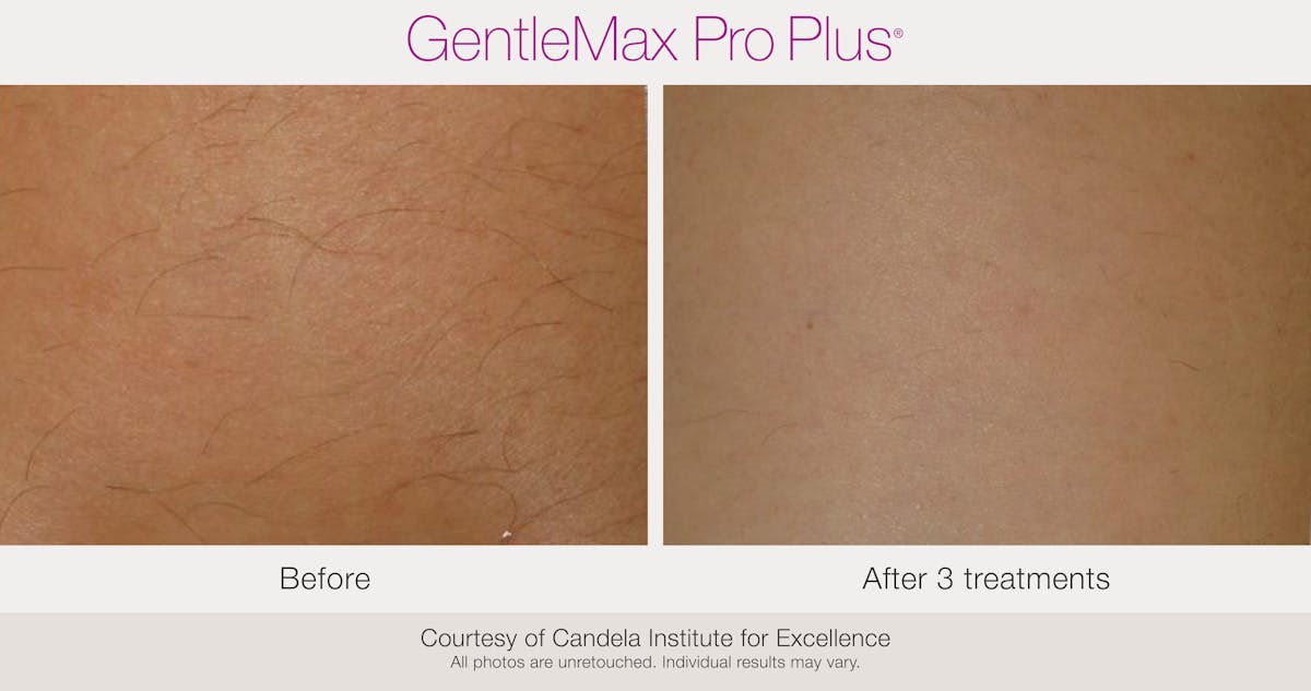 Laser Hair Removal Before & After Gallery - Patient 130156936 - Image 1