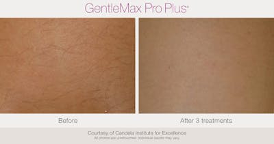 Laser Hair Removal Before & After Gallery - Patient 130156936 - Image 1