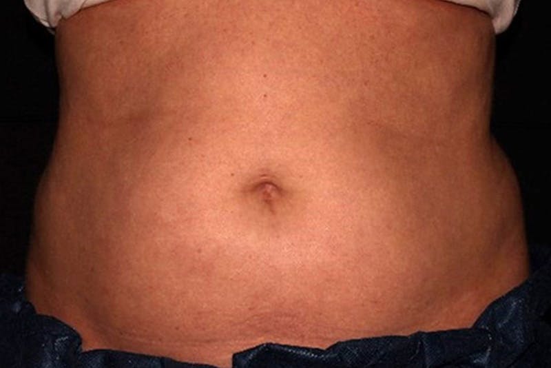 CoolSculpting Elite Before & After Gallery - Patient 154102 - Image 1
