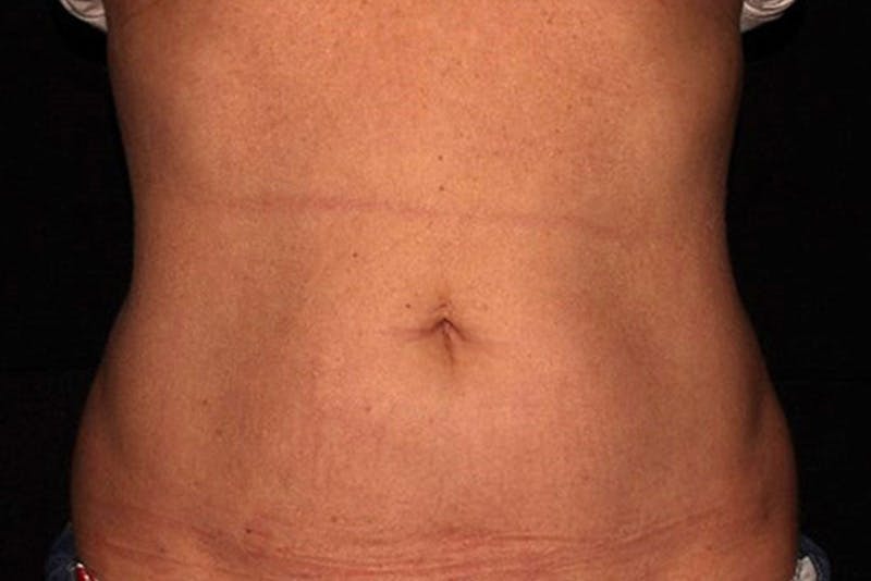 CoolSculpting Elite Before & After Gallery - Patient 154102 - Image 2