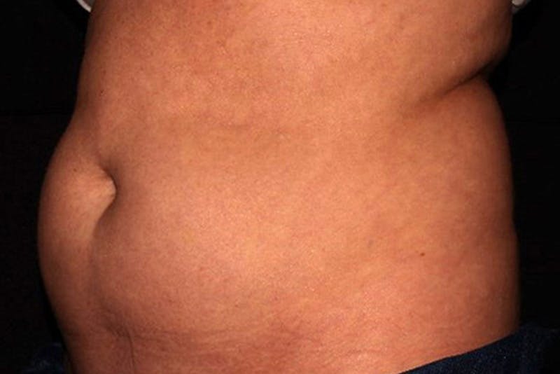 CoolSculpting Elite Before & After Gallery - Patient 154102 - Image 3