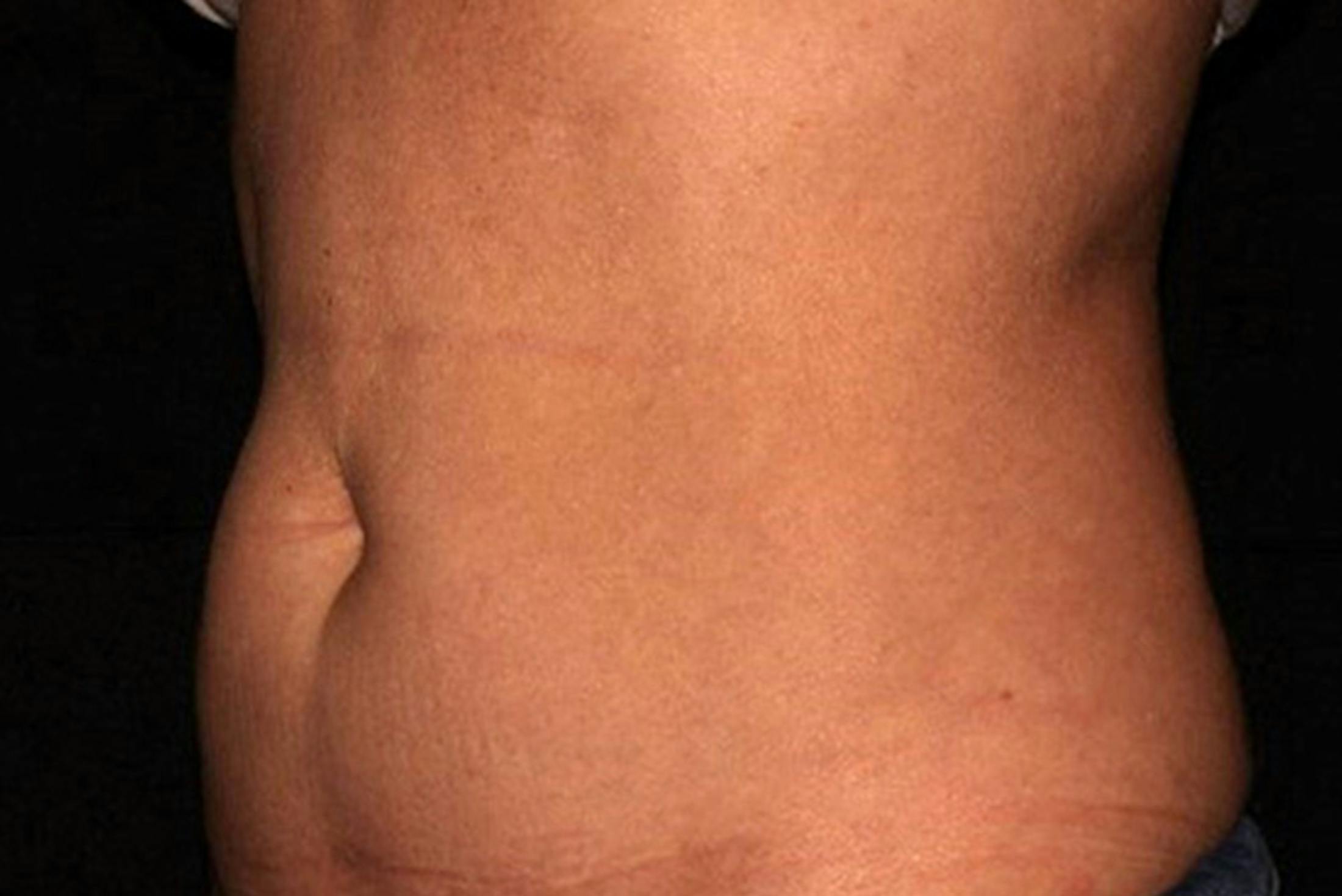 CoolSculpting Elite
