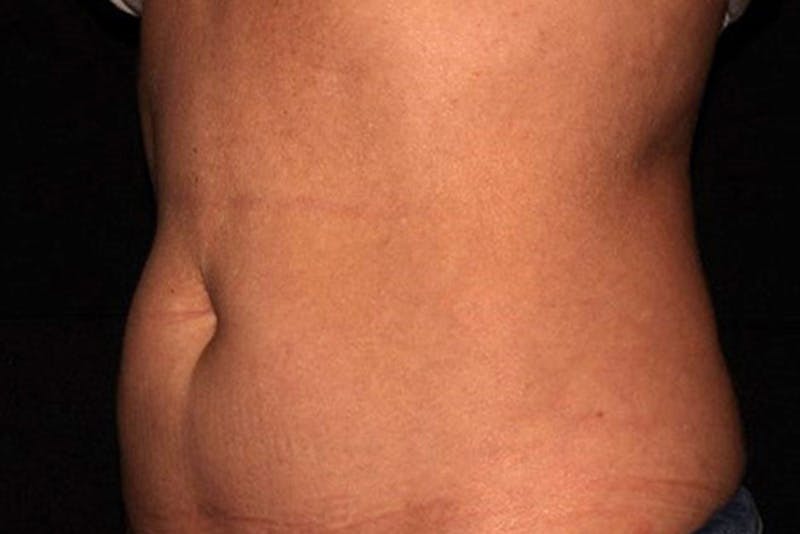 CoolSculpting Elite Before & After Gallery - Patient 154102 - Image 4