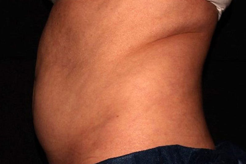 CoolSculpting Elite Before & After Gallery - Patient 154102 - Image 5