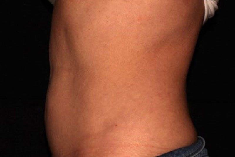 CoolSculpting Elite Before & After Gallery - Patient 154102 - Image 6