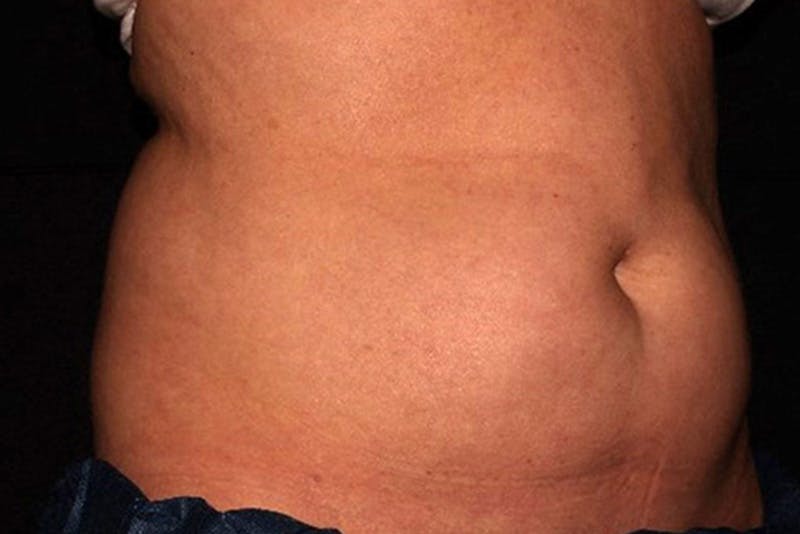 CoolSculpting Elite Before & After Gallery - Patient 154102 - Image 7