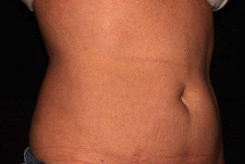 CoolSculpting Elite Before & After Gallery - Patient 154102 - Image 8