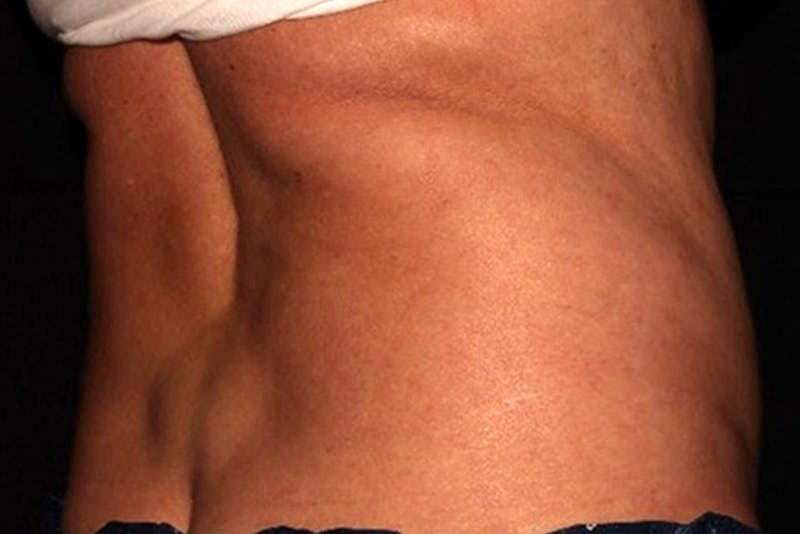 CoolSculpting Elite Before & After Gallery - Patient 154102 - Image 9
