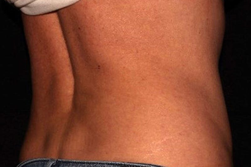 CoolSculpting Elite Before & After Gallery - Patient 154102 - Image 10