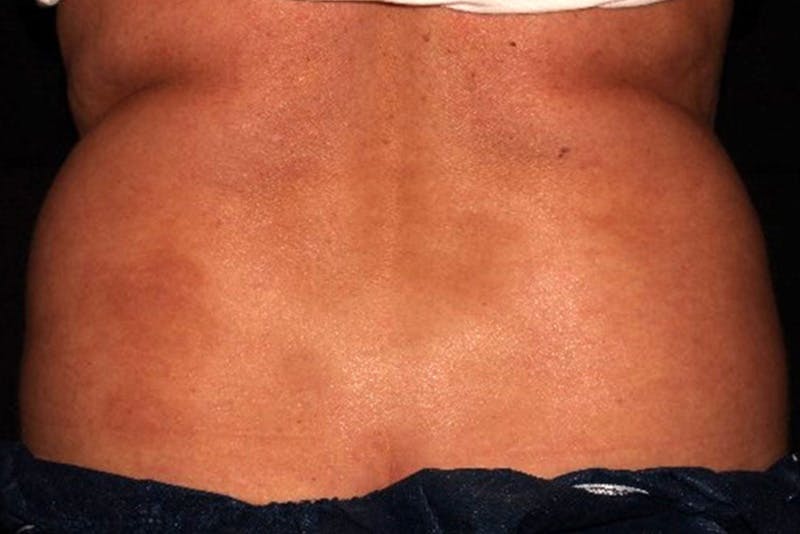 CoolSculpting Elite Before & After Gallery - Patient 154102 - Image 11