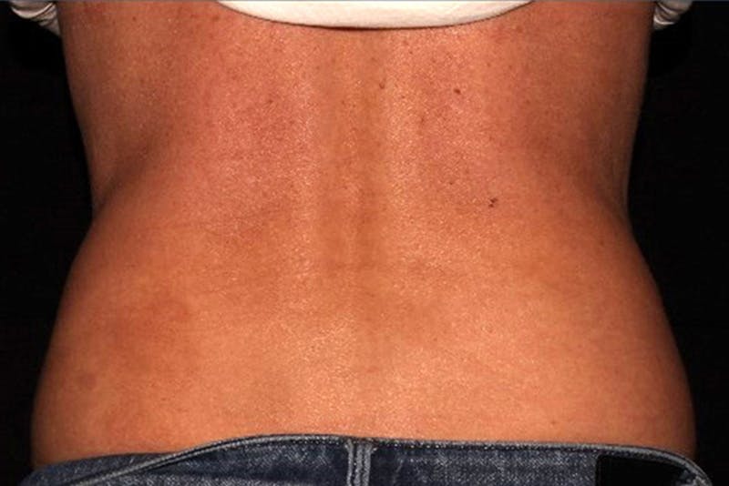 CoolSculpting Elite Before & After Gallery - Patient 154102 - Image 12