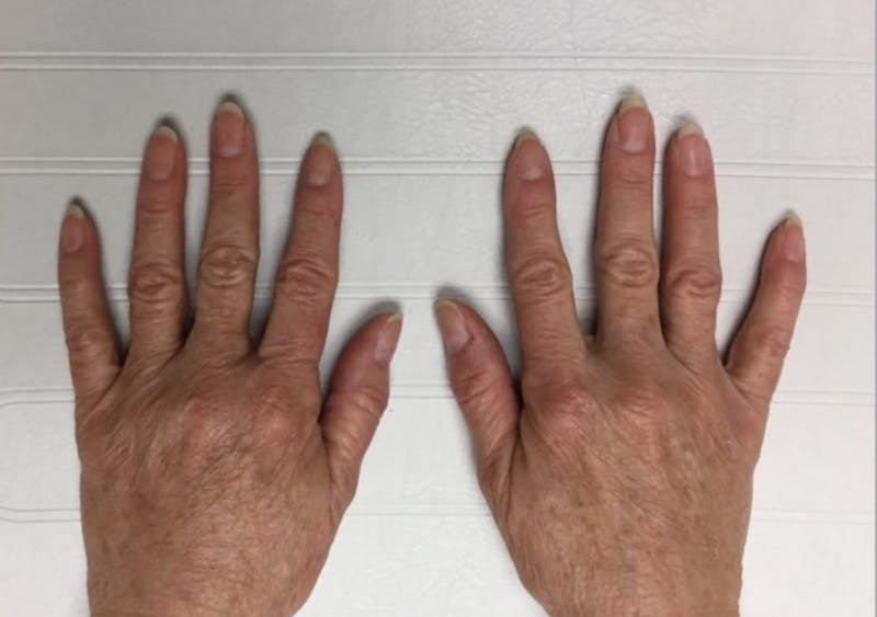 Hand Filler Before & After Gallery - Patient 815362 - Image 2
