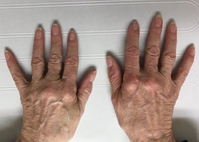 Hand Filler Before & After Gallery - Patient 815362 - Image 1