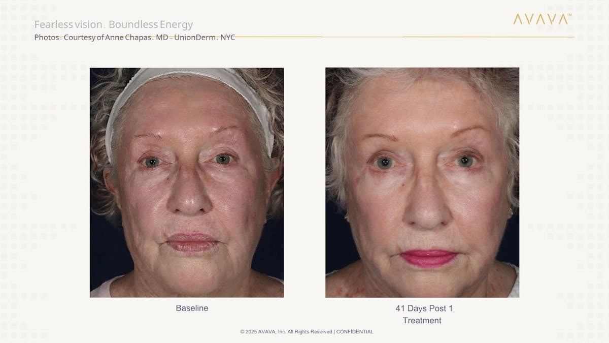 AVAVA Laser Before & After Gallery - Patient 166272 - Image 1