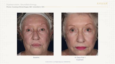 AVAVA Laser Before & After Gallery - Patient 166272 - Image 1