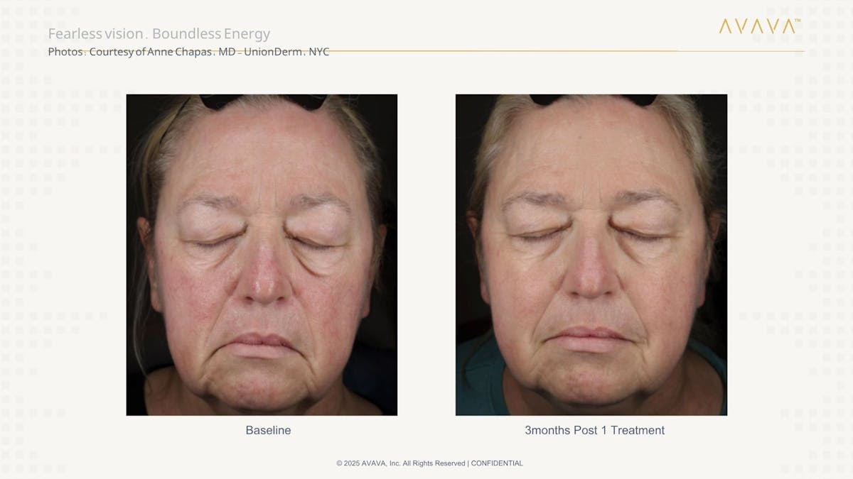 AVAVA Laser Before & After Gallery - Patient 326624 - Image 1