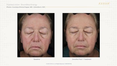 AVAVA Laser Before & After Gallery - Patient 326624 - Image 1