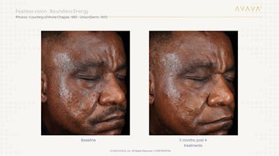 AVAVA Laser Before & After Gallery - Patient 223177 - Image 1