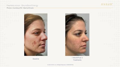 AVAVA Laser Before & After Gallery - Patient 532731 - Image 1