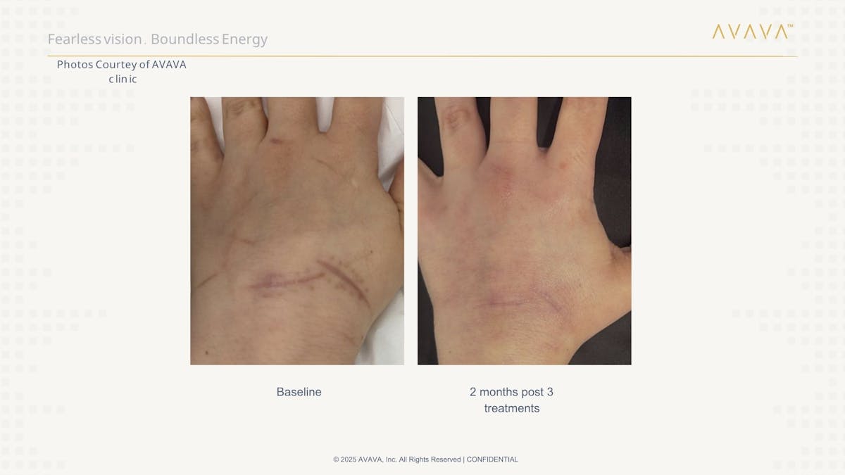 AVAVA Laser Before & After Gallery - Patient 259014 - Image 2