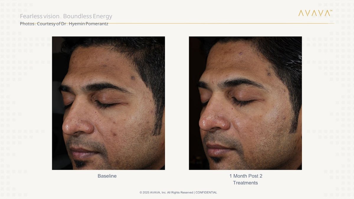 AVAVA Laser Before & After Gallery - Patient 107008 - Image 3