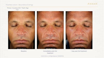 AVAVA Laser Before & After Gallery - Patient 232888 - Image 1