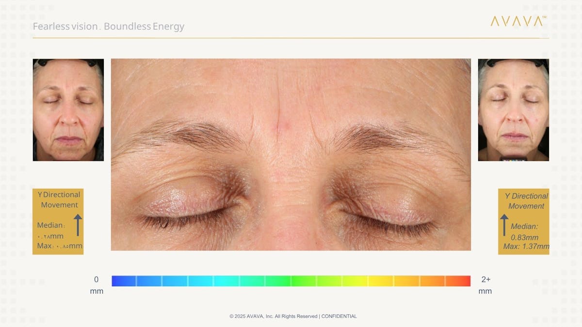 AVAVA Laser Before & After Gallery - Patient 325836 - Image 2