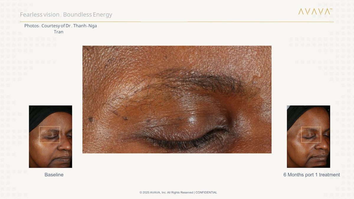AVAVA Laser Before & After Gallery - Patient 821270 - Image 2
