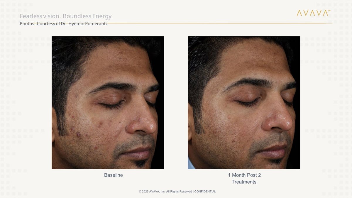 AVAVA Laser Before & After Gallery - Patient 107008 - Image 2