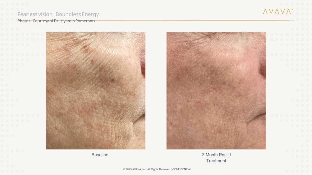 AVAVA Laser Before & After Gallery - Patient 193589 - Image 2