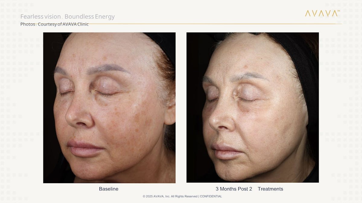 AVAVA Laser Before & After Gallery - Patient 288472 - Image 1