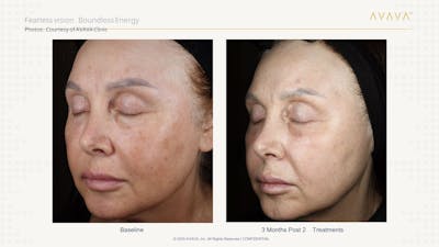 AVAVA Laser Before & After Gallery - Patient 288472 - Image 1