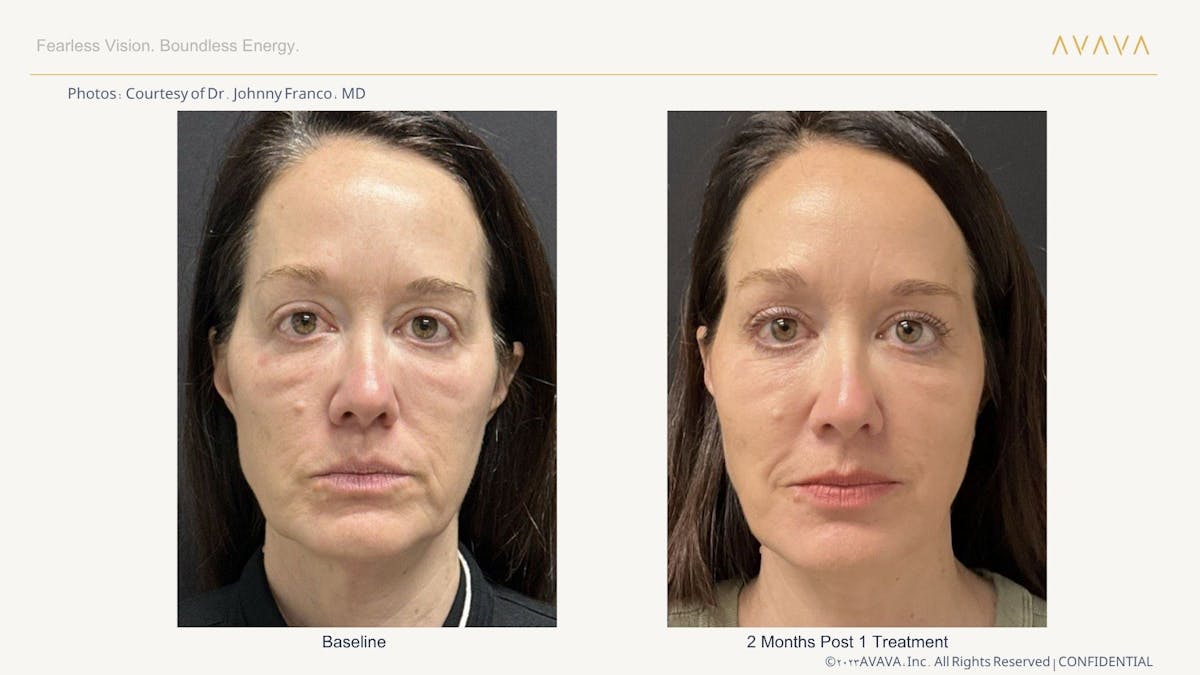 AVAVA Laser Before & After Gallery - Patient 425705 - Image 1