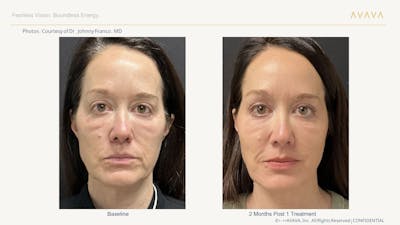 AVAVA Laser Before & After Gallery - Patient 425705 - Image 1