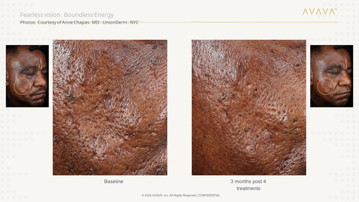 AVAVA Laser Before & After Gallery - Patient 223177 - Image 2