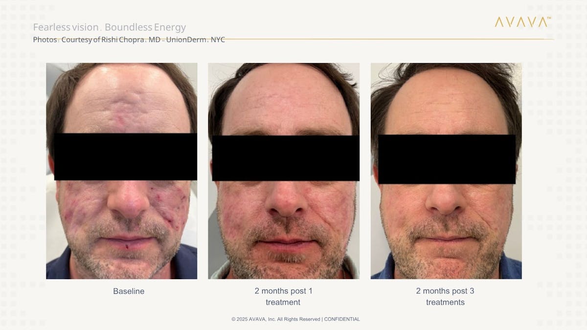 AVAVA Laser Before & After Gallery - Patient 170637 - Image 1