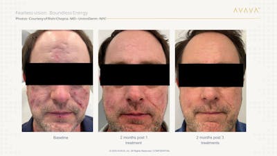 AVAVA Laser Before & After Gallery - Patient 170637 - Image 1