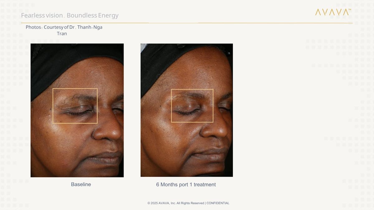 AVAVA Laser Before & After Gallery - Patient 821270 - Image 1