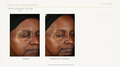 AVAVA Laser Before & After Gallery - Patient 821270 - Image 1